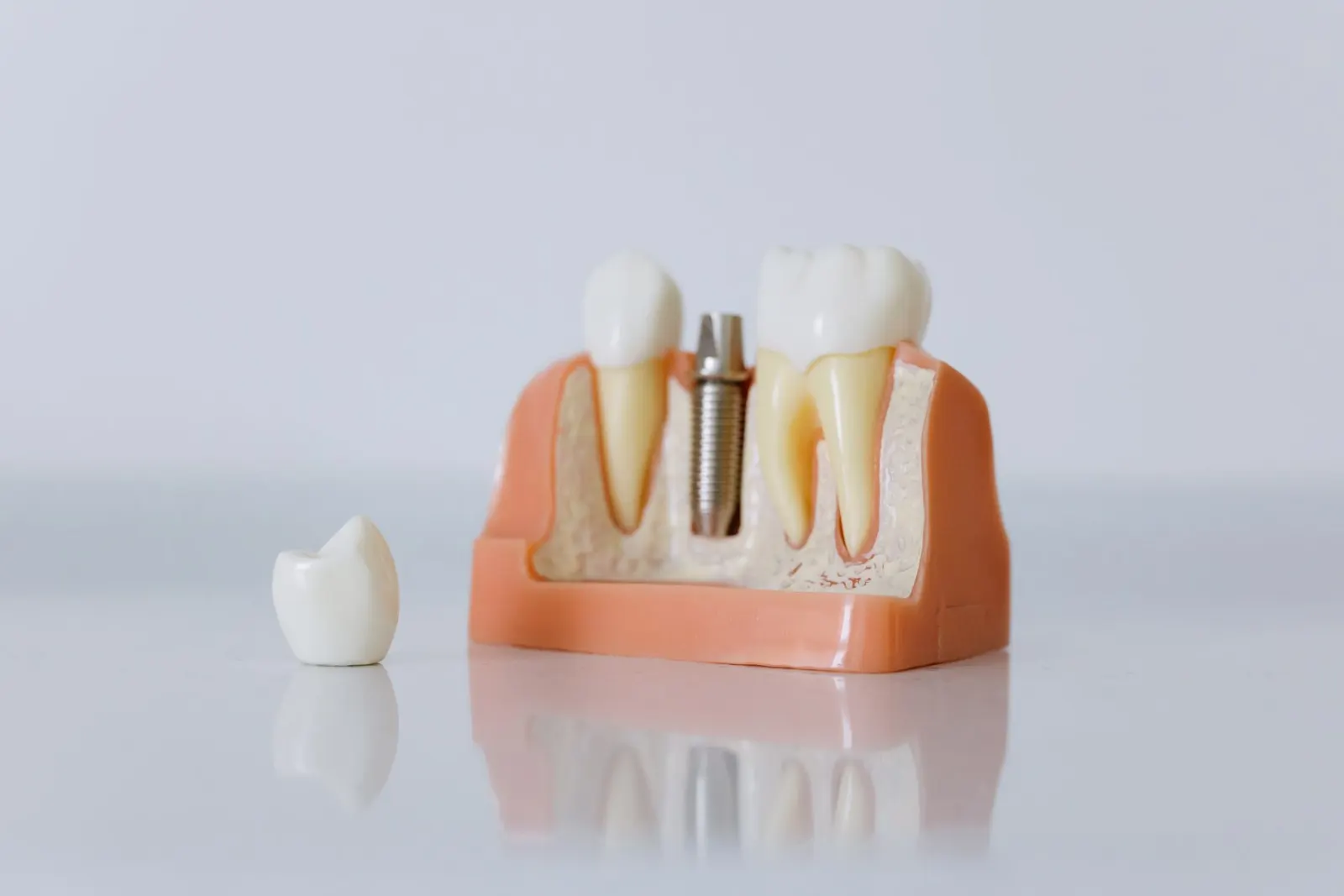 Dental Implant or Bridge: How to Decide