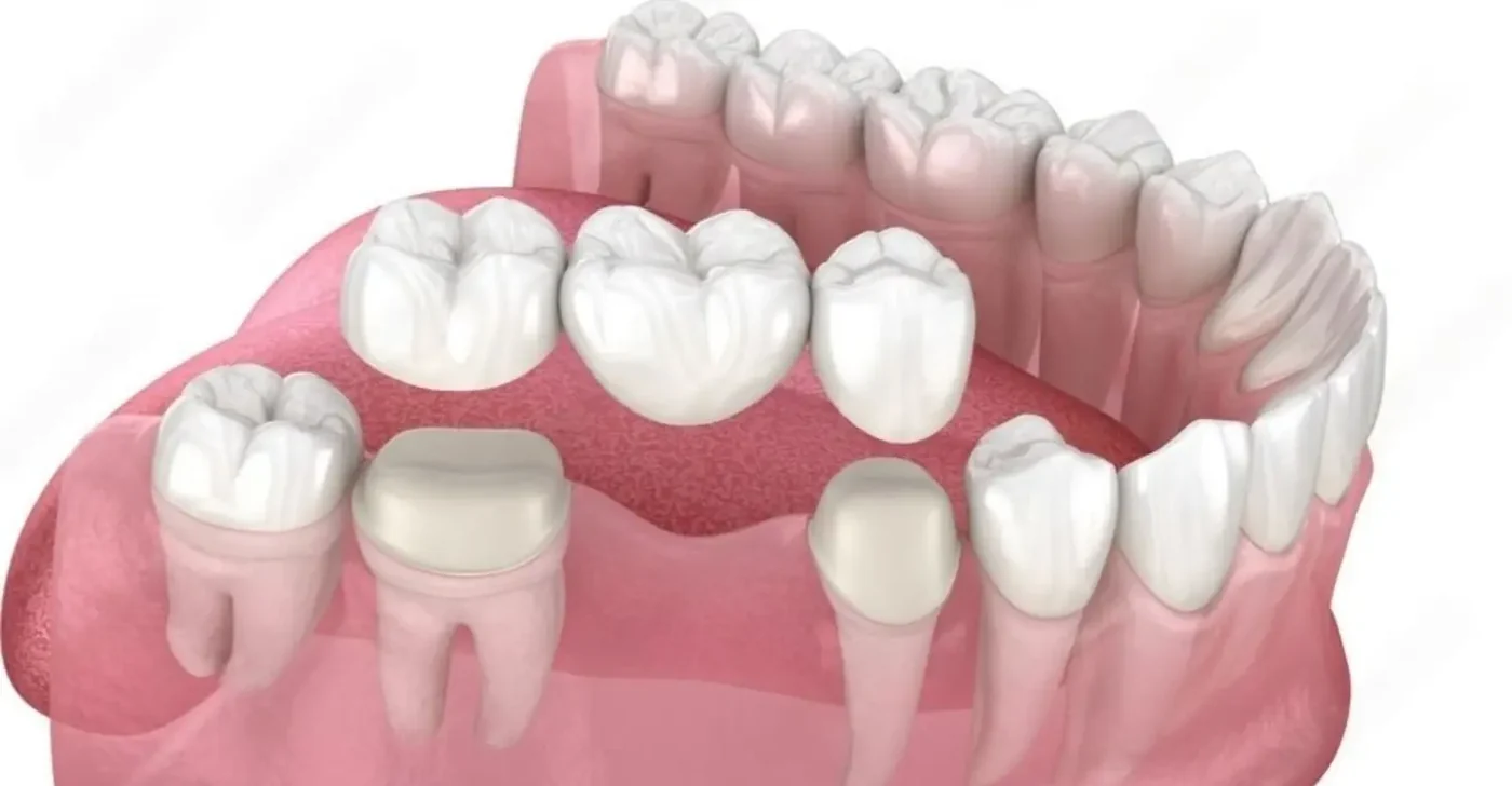 Dental Bridges