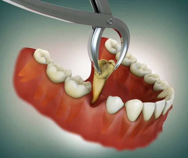 Tooth Extractions