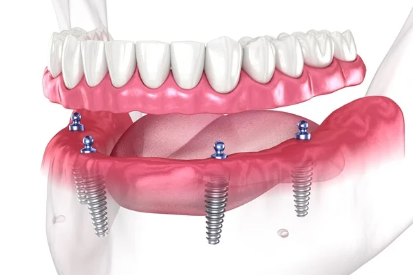 Implant-Supported Dentures