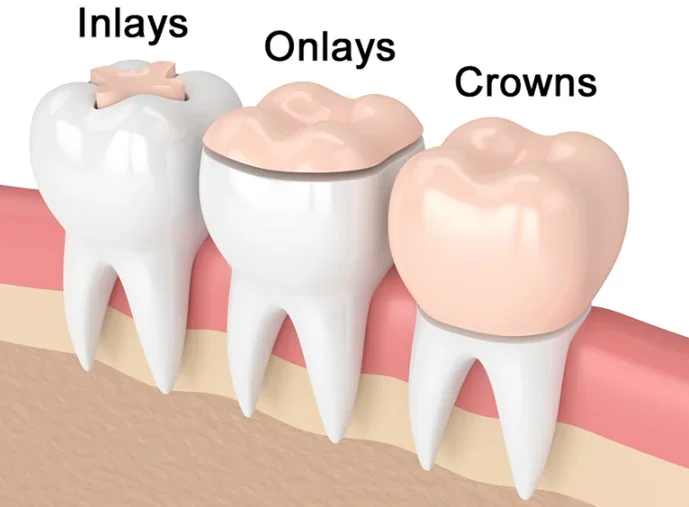 Inlays and Onlays