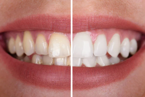 Professional Teeth Whitening