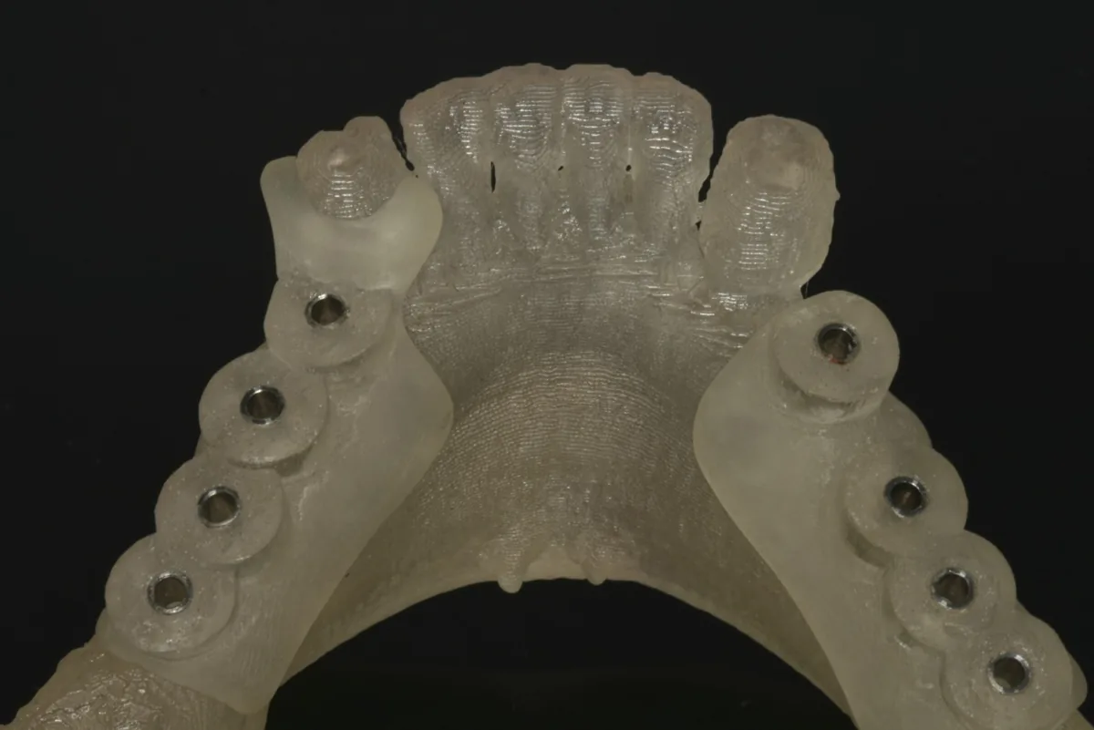 A 3D-printed surgical guide for implant placement, on a model of the jaw